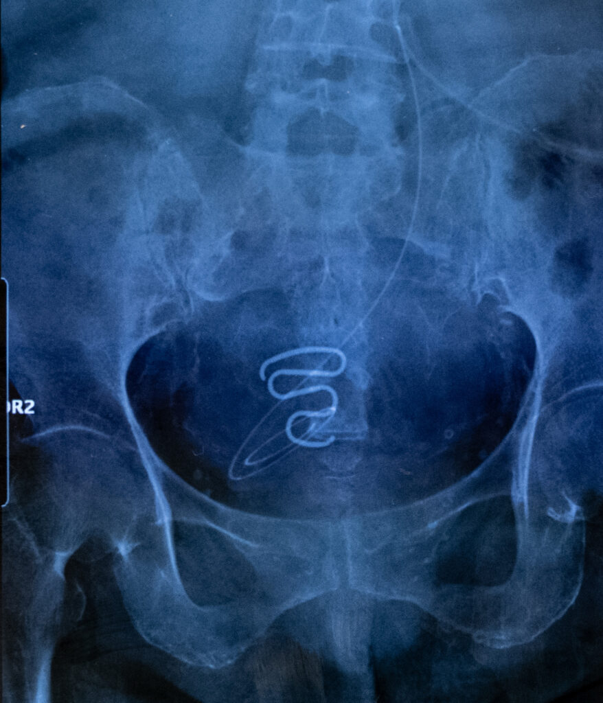 Radiographie montrant un stérilet, plus communément appelé “spirale“ utilisé pendant la campagne de stérilisation (Spiralkampagnen) des Groenlandaises de 1966 à 1975. Ces stérilets étaient beaucoup trop gros et inadaptés aux corps des jeunes adolescentes, les plus jeunes n’avaient que 12 ans lors de la pose. En plus de la douleur et des saignements, ces “spirales“ sont également à l’origine de graves infections qui ont rendu leurs victimes définitivement stériles.